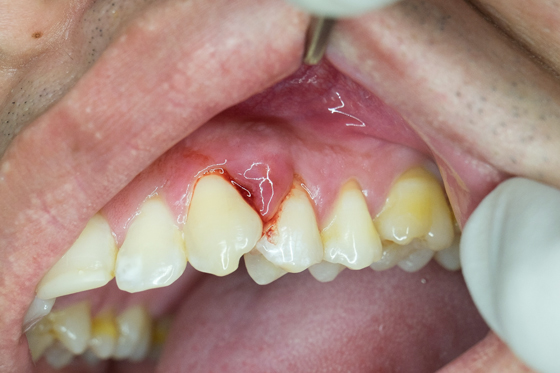 Nhận biết dấu hiệu sưng chân răng để dễ dàng có biện pháp xử lý sớm
