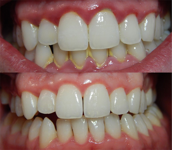  Cạo vôi răng thường xuyên sẽ tránh được tình trạng sưng chân răng