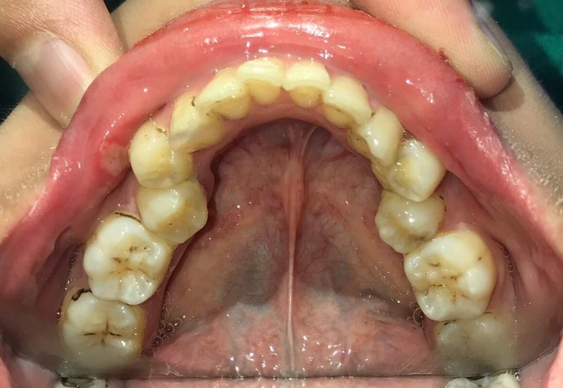 Răng sai khớp cắn khiến tình trạng ăn nhai cũng khó khăn