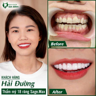Hình ảnh khách hàng trước và sau khi làm răng sứ
