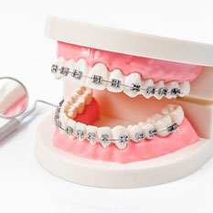 Sự thay đổi của hàm sau khi khi thực hiện phương pháp niềng răng mắc cài kim loại