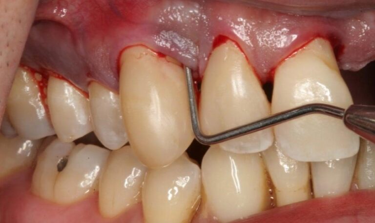 Những tác hại khi lấy cao răng sai kỹ thuật