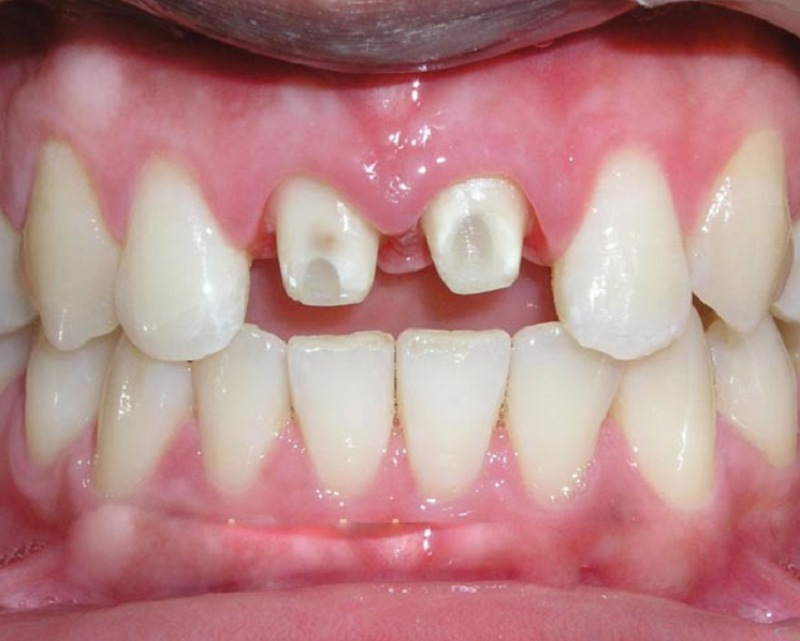 Mài răng quá nhiều không đúng kỹ thuật cũng gây hở chân răng sau khi bọc sứ