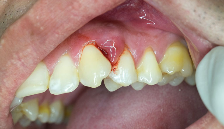  Chảy máu chân răng thường xuyên có thể là triệu chứng của viêm nha chu