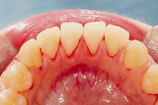 Chảy máu chân răng thường xuyên hoặc sưng nướu răng có thể là dấu hiệu cảnh báo của bệnh tiểu đường loại 1 hoặc loại 2.
