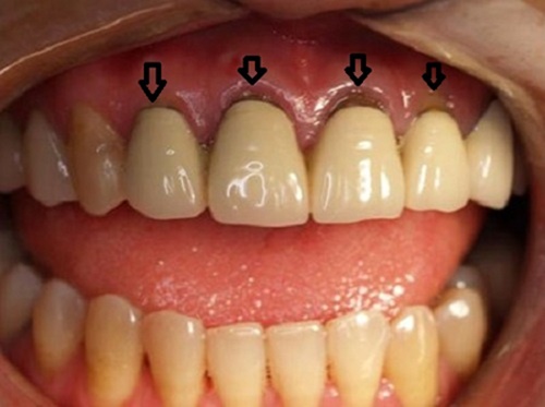 Dấu hiệu nhận biết răng sứ tụt nướu
