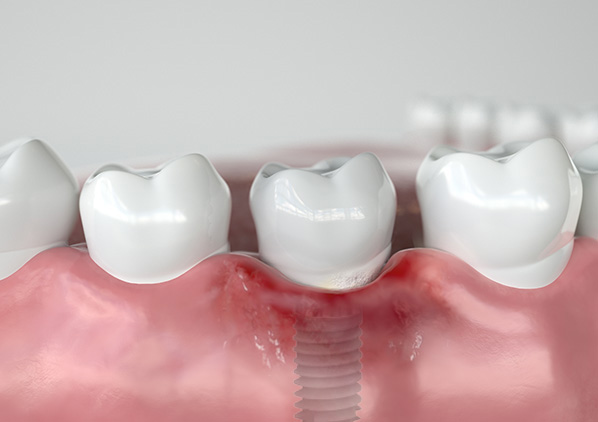 Trồng răng giá rẻ liệu có an toàn không?