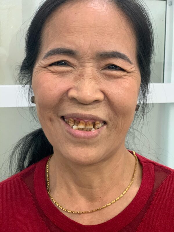 Hình ảnh răng trước của cô Loan