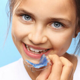 Niềng răng cho trẻ đúng độ tuổi mang lại hiệu quả cao