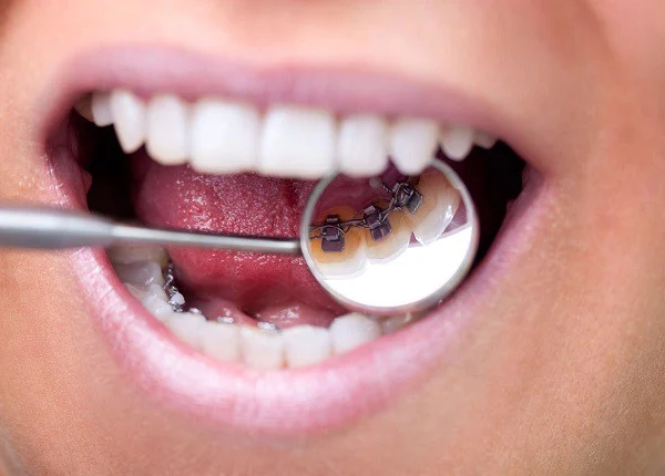 Sâu răng khi niềng phải xử lý thế nào?
