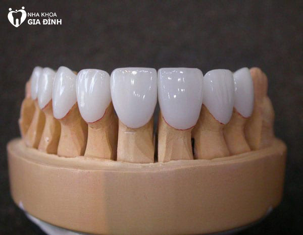 Răng toàn sứ có độ bền cao hơn