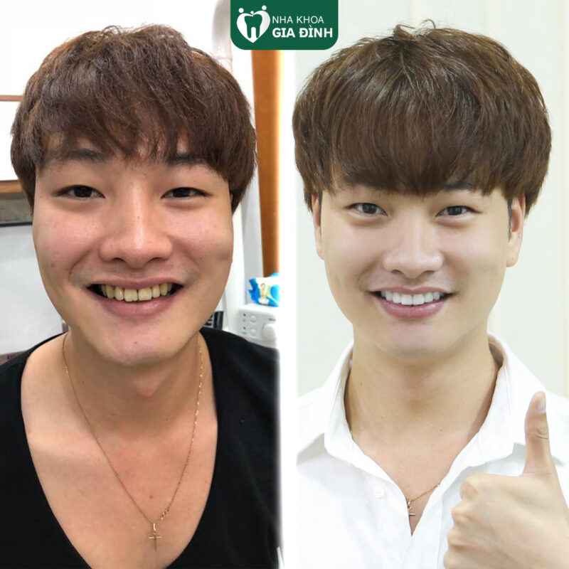 Hình ảnh trước và sau khi làm răng thẩm mỹ của Trong Lân