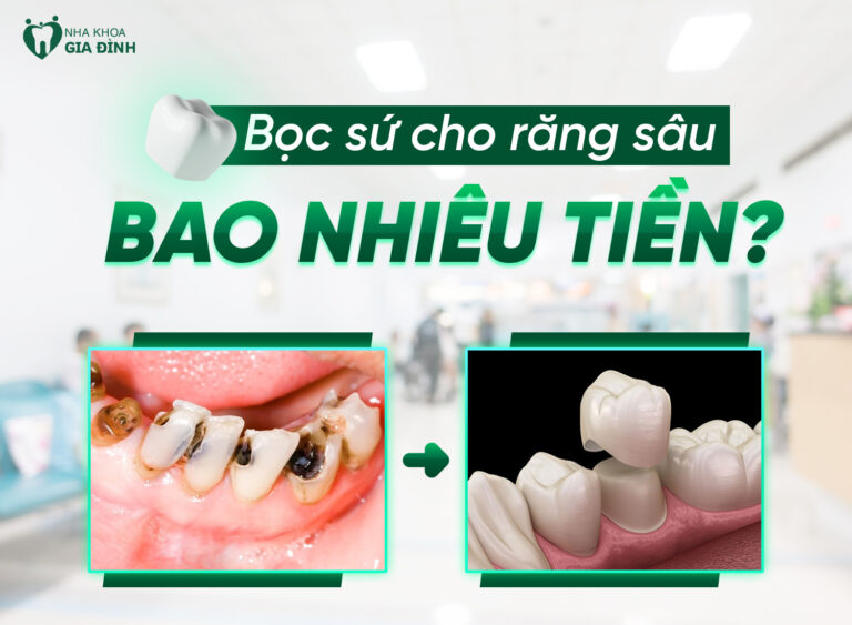 Top 3+ vấn đề bọc răng sứ cho răng sâu cần quan tâm