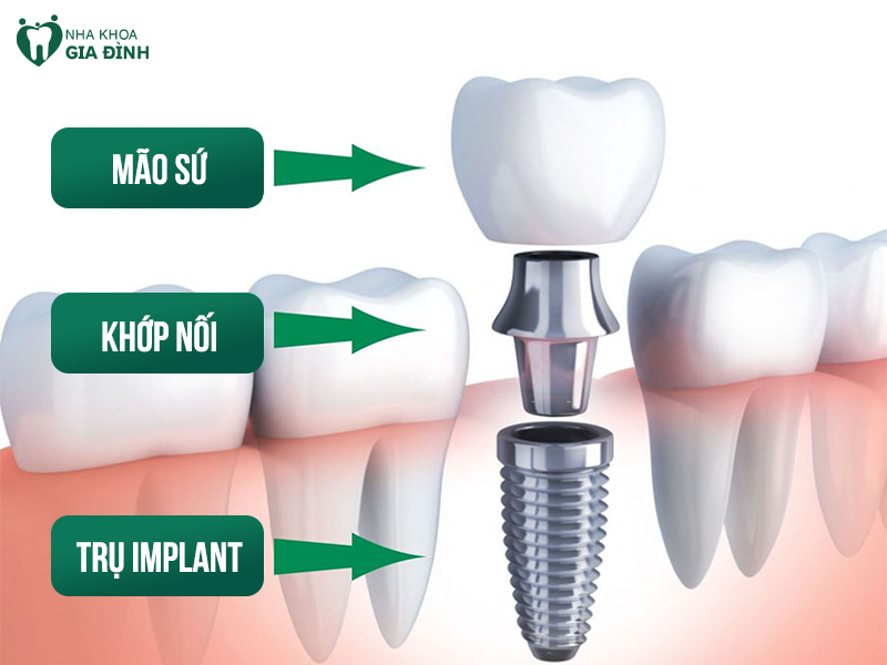 Trồng răng Implant là gì? Cấu tạo của Implant