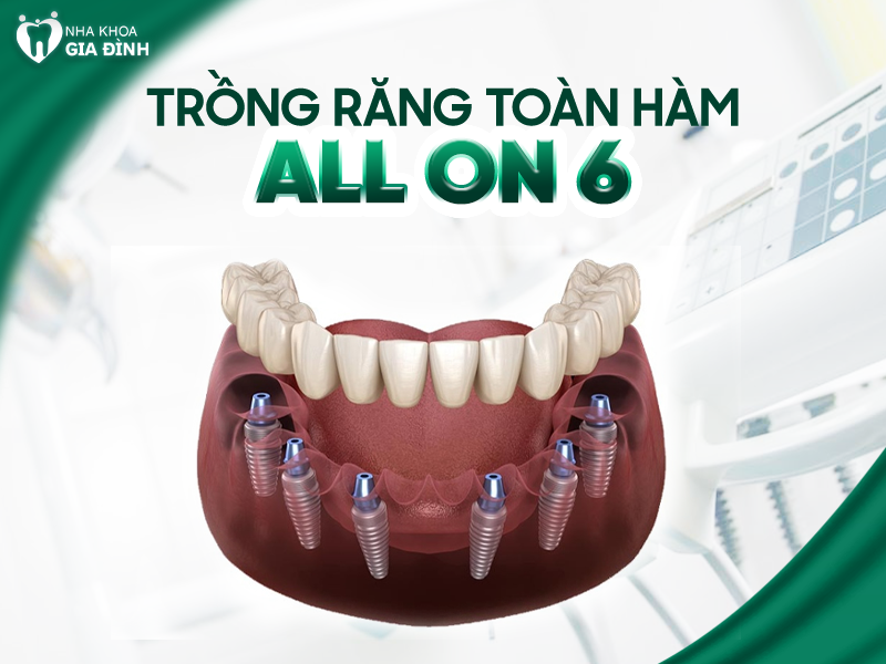 Tìm hiểu về kỹ thuật trồng răng implant toàn hàm All-on-6