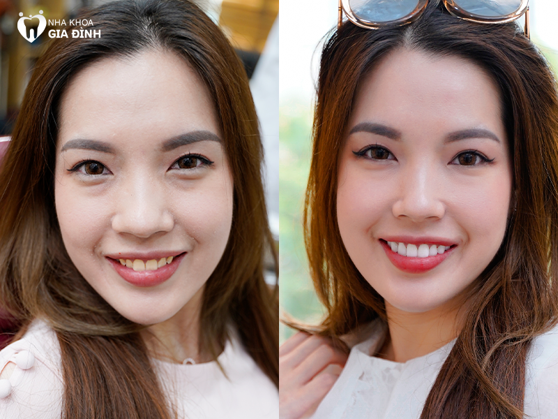 Khách hàng Hoài Linh thực hiện dịch vụ thẩm mỹ 20 răng Veneer Ultrathin