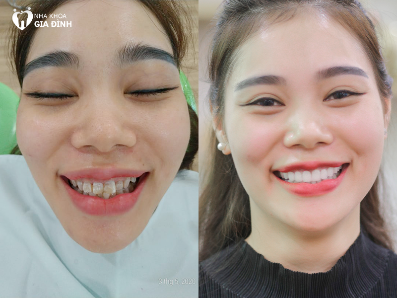 Khách hàng Nguyễn Kiều Oanh thực hiện thẩm mỹ 20 răng sứ Emax cải thiện tình trạng răng tối màu, nhiễm màu kháng sinh