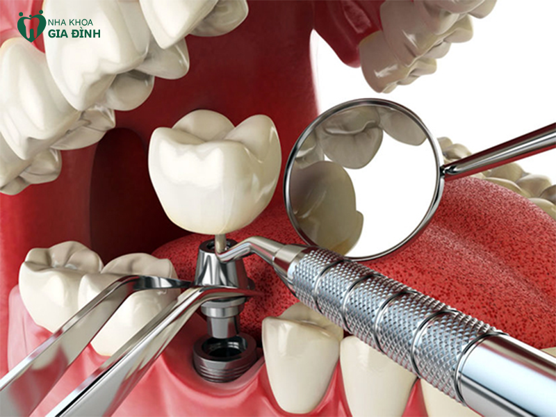Bảng giá trồng răng implant niêm yết rõ ràng, tối ưu số 1 Hà Nội