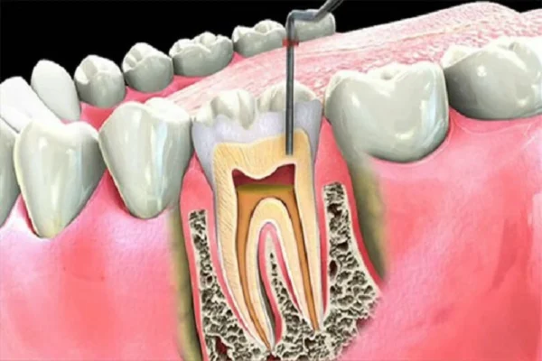 Răng như thế nào thì nên điều trị tủy càng sớm càng tốt