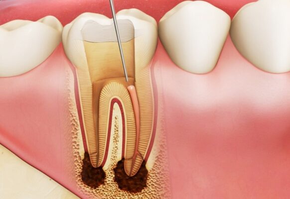 Có những dạng viêm tủy răng nào