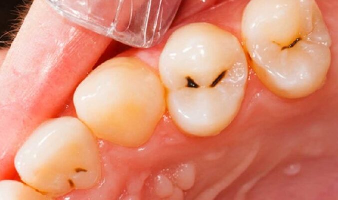 Răng như thế nào thì nên điều trị tủy càng sớm càng tốt