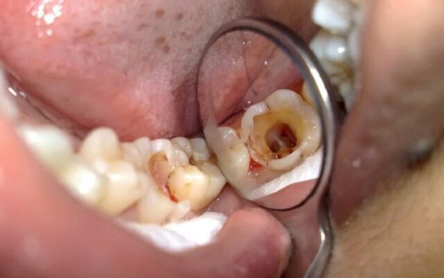 Viêm tủy răng nguy hiểm như thế nào?
