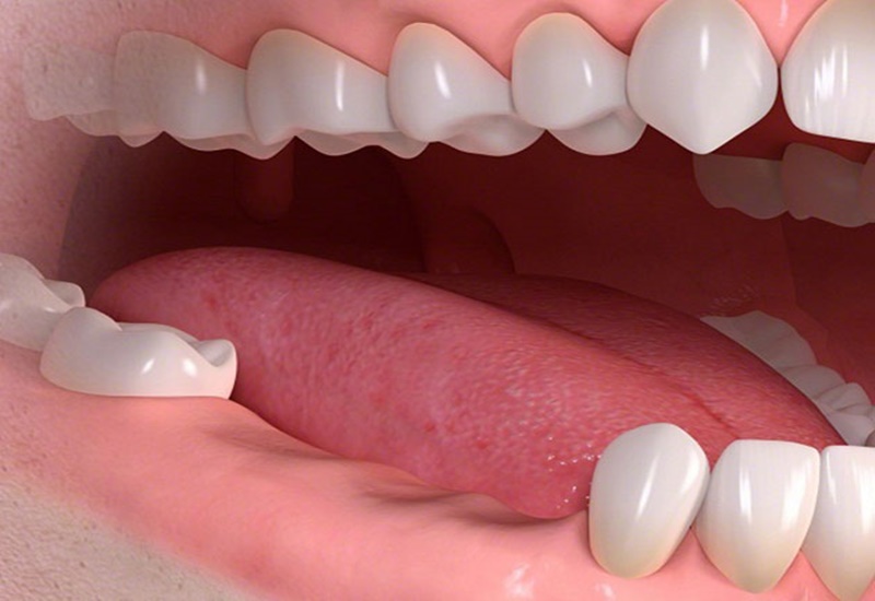 Ưu Và Nhược Điểm Của Kỹ Thuật Cấy Ghép Implant All On 4 20221207 Implant All On 4 2