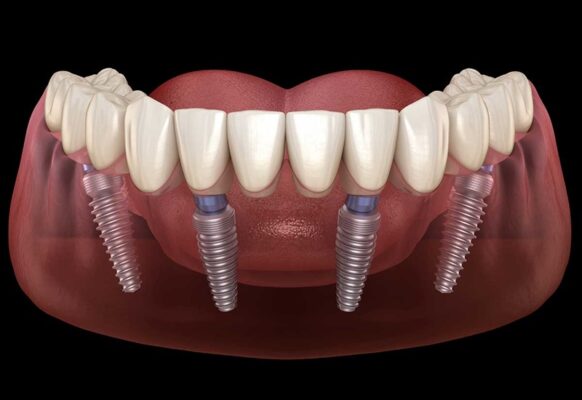 20221207 Implant All On 4 3