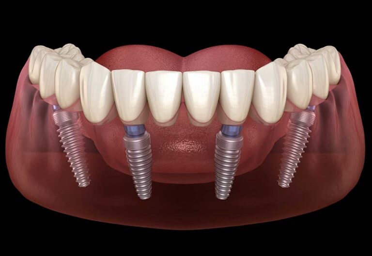 Ưu Và Nhược Điểm Của Kỹ Thuật Cấy Ghép Implant All On 4 Ưu Và Nhược Điểm Của Kỹ Thuật Cấy Ghép Implant All On 4