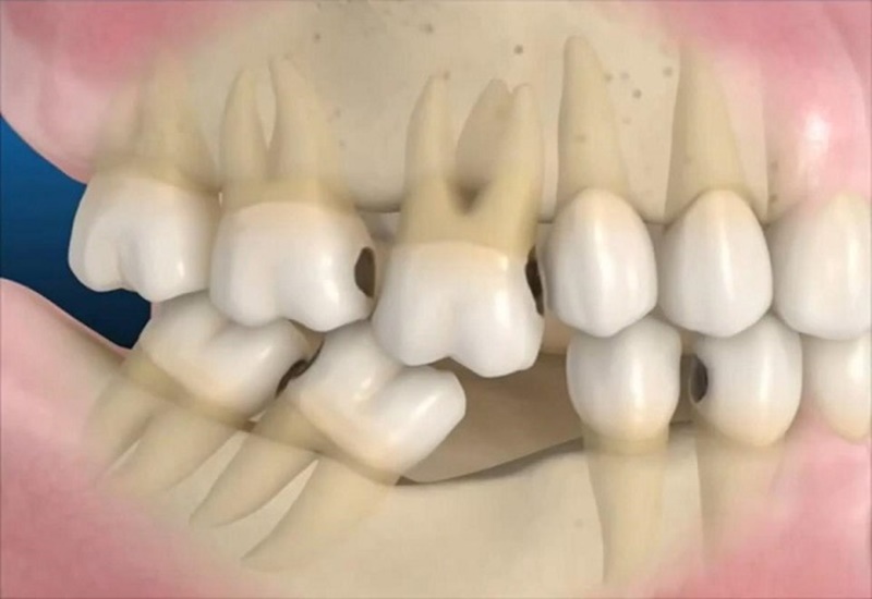 Ưu Và Nhược Điểm Của Kỹ Thuật Cấy Ghép Implant All On 4 20221207 Implant All On 4 4
