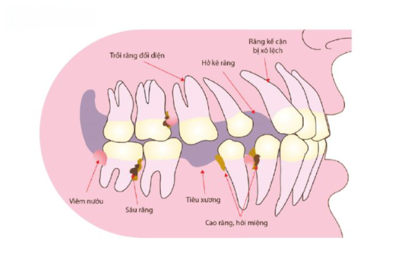Tiêu Xương Hàm Là Gì? Dấu Hiệu Nhận Biết, Nguồn Gốc và Cách Ngăn Ngừa