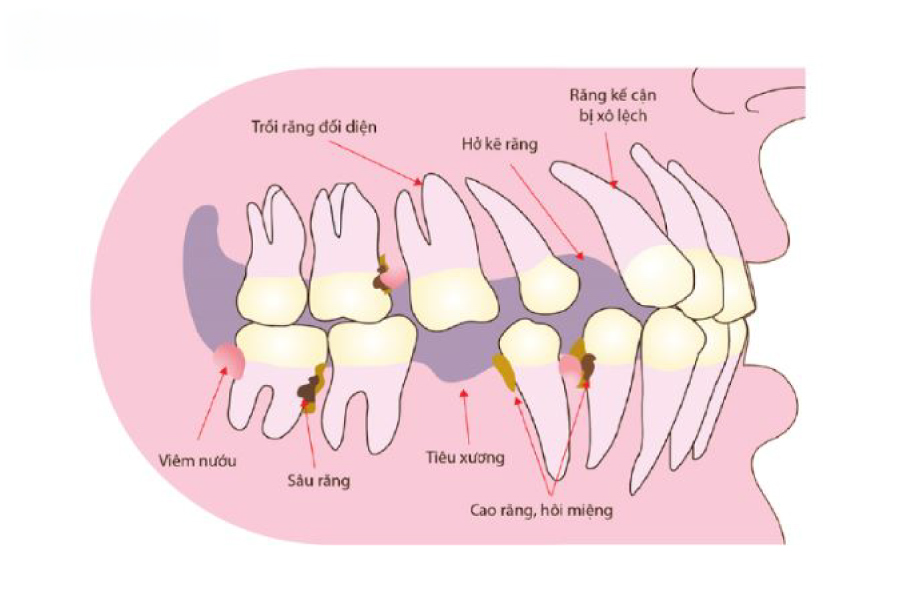 Tiêu Xương Hàm Là Gì? Dấu Hiệu Nhận Biết, Nguồn Gốc và Cách Ngăn Ngừa W10