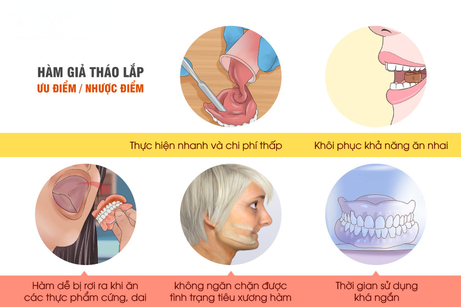 Các Giải Pháp Phục Hình Tối Ưu Khi Mất Răng? Đánh Giá Ưu và Nhược Điểm W12.2