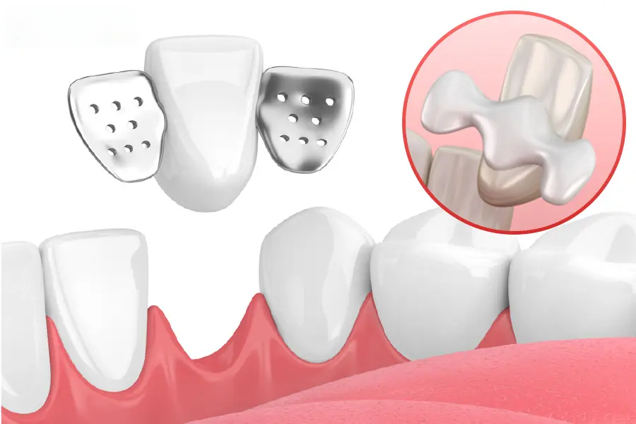 Các Giải Pháp Phục Hình Tối Ưu Khi Mất Răng? Đánh Giá Ưu và Nhược Điểm W12.3