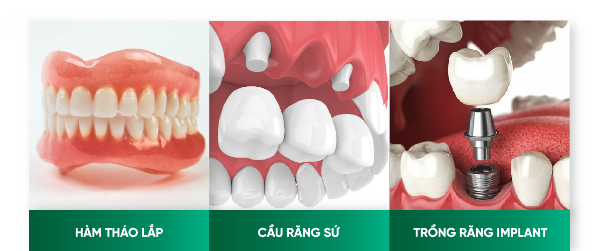 Các Giải Pháp Phục Hình Tối Ưu Khi Mất Răng? Đánh Giá Ưu và Nhược Điểm W12.4