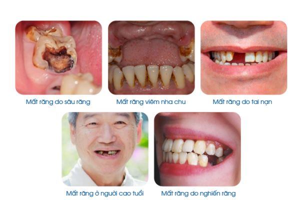 Mất Răng: Nguyên Nhân, Tác Hại Và Các Giải Pháp Phục Hồi Hiệu Quả W5