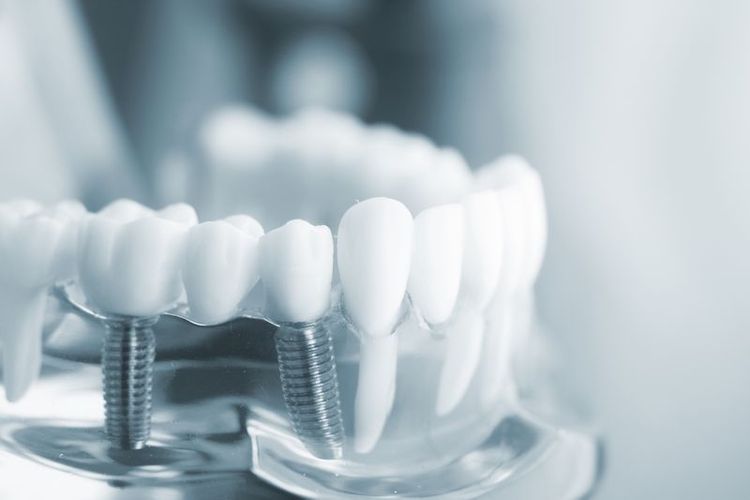 Lựa Chọn Phục Hình Răng: Cầu Răng Sứ Hay Cấy Ghép Implant?