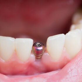 nhung uu diem cua trong rang implant doi tuong can implant