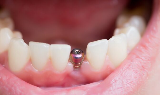 Trồng răng Implant có đau không? nhung uu diem cua trong rang implant doi tuong can implant