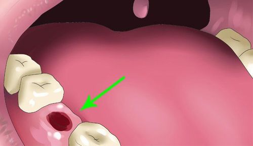Lựa Chọn Phục Hình Răng: Cầu Răng Sứ Hay Cấy Ghép Implant?