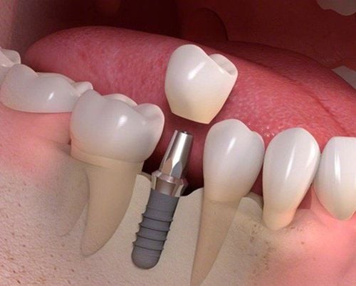 Mất răng hàm có ảnh hưởng gì không?