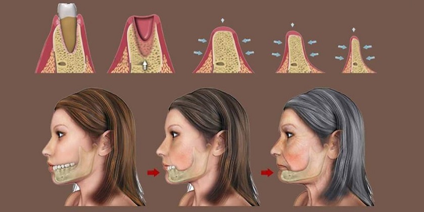 Mất Răng Lâu Năm Có Phục Hồi Được Không? Giải Pháp Nào Là Tối Ưu? trong rang implant bi tieu xuong 4
