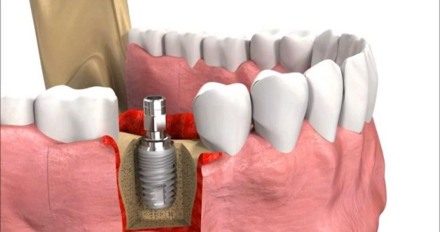 Răng implant bị lung lay do đâu? tru implant e1616486788993