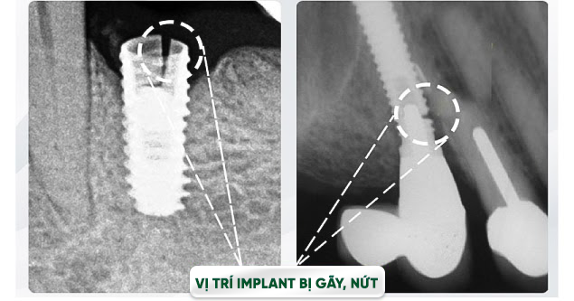Trồng răng implant có tác hại như thế nào? Biến chứng khi trồng Trồng răng implant có tác hại như thế nào? Biến chứng khi trồng